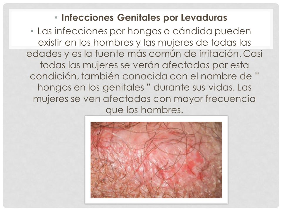 Mujeres en candidiasis primeros de sintomas